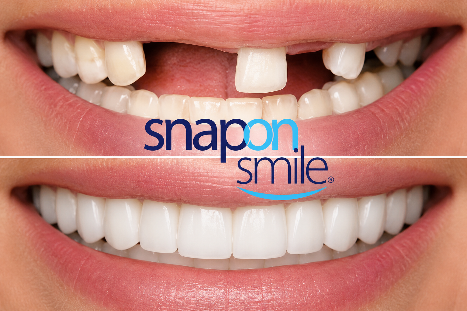 Esempio estetico Snap On Smile