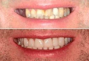 Prima e dopo cliente Davide con barba